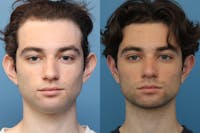 Dr. Francis Otoplasty Before & After Gallery - Patient 156740558 - Image 1