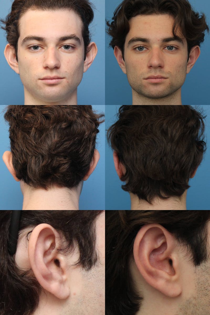 Dr. Francis Otoplasty Before & After Gallery - Patient 156740558 - Image 2
