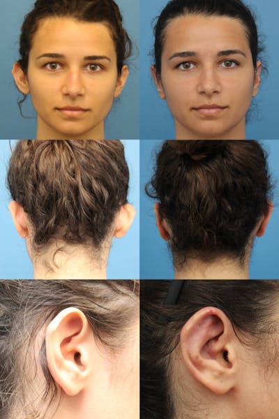 Dr. Francis Otoplasty Before & After Gallery - Patient 156740559 - Image 2