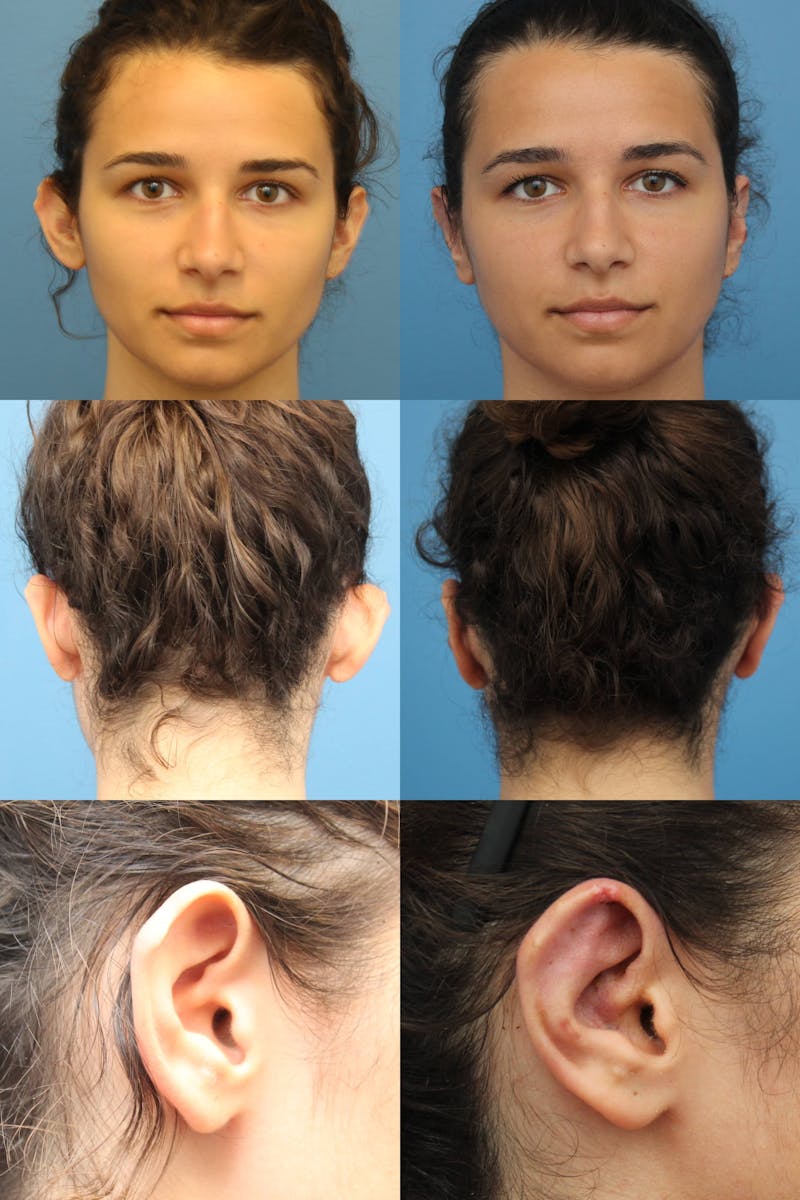 Dr. Francis Otoplasty Before & After Gallery - Patient 156740559 - Image 2