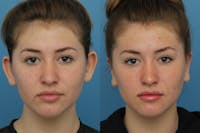 Dr. Francis Otoplasty Before & After Gallery - Patient 156740560 - Image 1