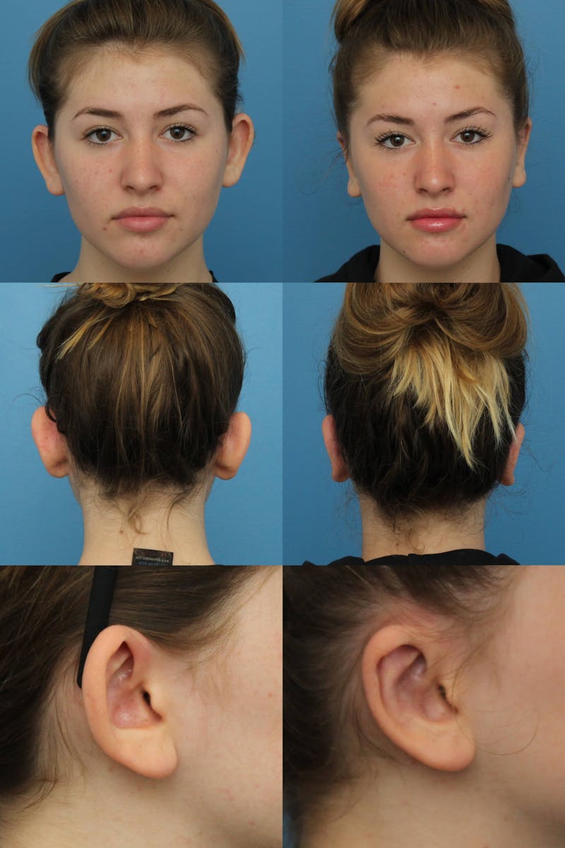Dr. Francis Otoplasty Before & After Gallery - Patient 156740560 - Image 2