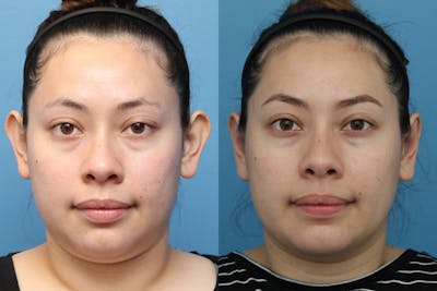 Dr. Francis Otoplasty Before & After Gallery - Patient 156740561 - Image 1