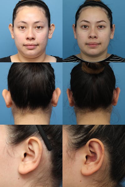 Dr. Francis Otoplasty Before & After Gallery - Patient 156740561 - Image 2