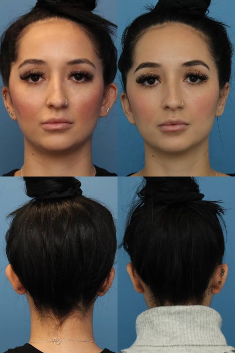 Dr. Francis Otoplasty Before & After Gallery - Patient 156740562 - Image 2