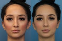 Dr. Francis Otoplasty Before & After Gallery - Patient 156740562 - Image 1