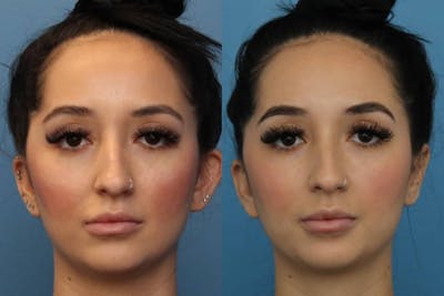 Dr. Francis Otoplasty Before & After Gallery - Patient 156740562 - Image 1