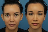 Dr. Francis Otoplasty Before & After Gallery - Patient 156740563 - Image 1