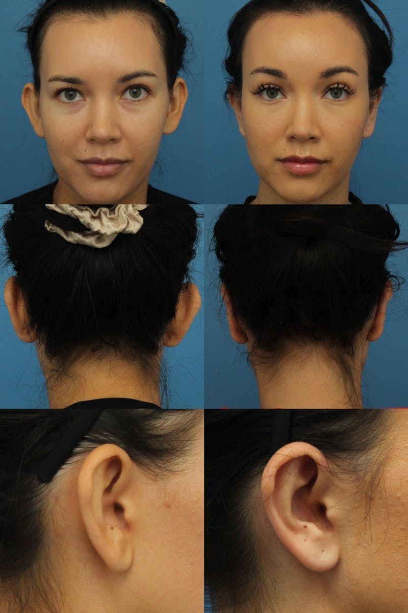 Dr. Francis Otoplasty Before & After Gallery - Patient 156740563 - Image 2