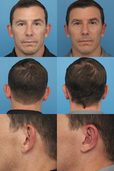 Dr. Francis Otoplasty Before & After Gallery - Patient 156740564 - Image 2