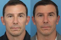 Dr. Francis Otoplasty Before & After Gallery - Patient 156740564 - Image 1