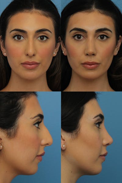 Dr. Francis Rhinoplasty Before & After Gallery - Patient 156740583 - Image 1