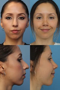 Dr. Francis Rhinoplasty Before & After Gallery - Patient 156740585 - Image 1