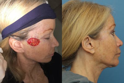 Dr. Francis Skin Cancer Reconstruction Before & After Gallery - Patient 156740604 - Image 1