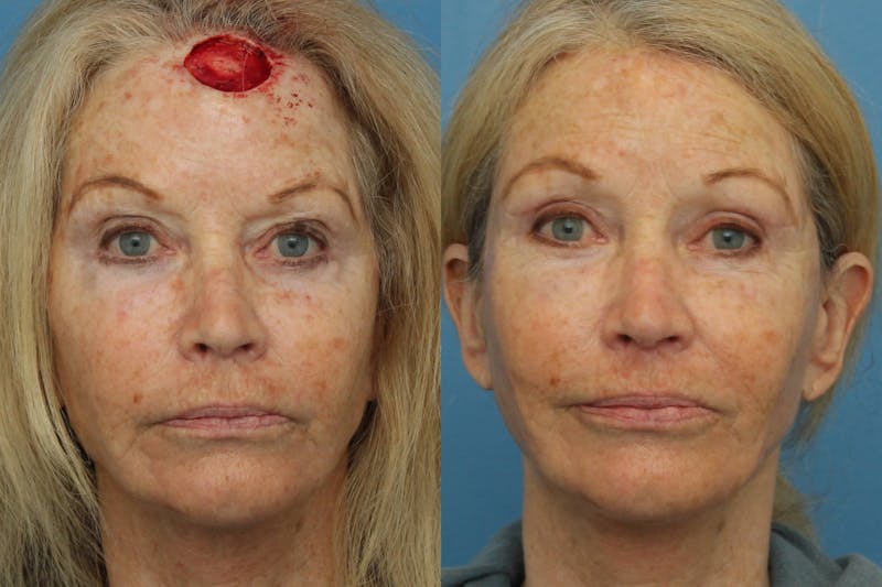 Dr. Francis Skin Cancer Reconstruction Before & After Gallery - Patient 156740605 - Image 1