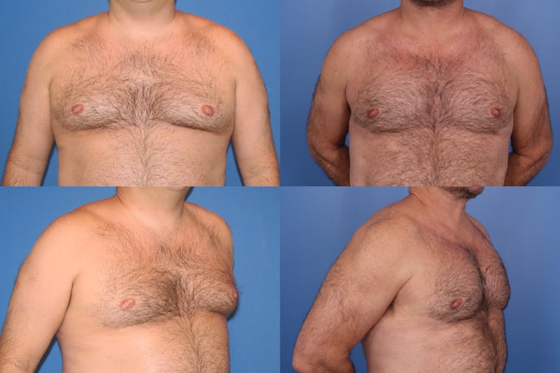 Male Breast Reduction/Gynecomastia Before & After Gallery - Patient 164620015 - Image 1
