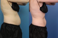 Coolsculpting Elite Before & After Gallery - Patient 189383385 - Image 1