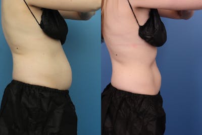 Coolsculpting Elite Before & After Gallery - Patient 189383385 - Image 1