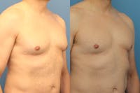 Coolsculpting Elite Before & After Gallery - Patient 189383386 - Image 1