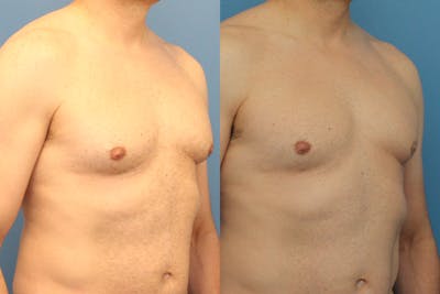 Coolsculpting Elite Before & After Gallery - Patient 189383386 - Image 1