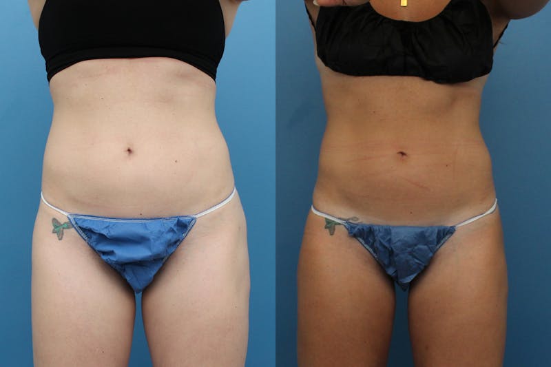 Coolsculpting Elite Before & After Gallery - Patient 189383191 - Image 1