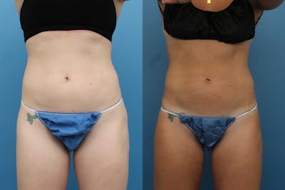 Coolsculpting Elite Before & After Gallery - Patient 189383191 - Image 1