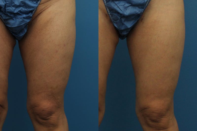 Coolsculpting Elite Before & After Gallery - Patient 189383189 - Image 1