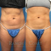 Coolsculpting Elite Before & After Gallery - Patient 189383828 - Image 1