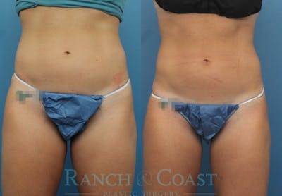 Coolsculpting Elite Before & After Gallery - Patient 189383870 - Image 1