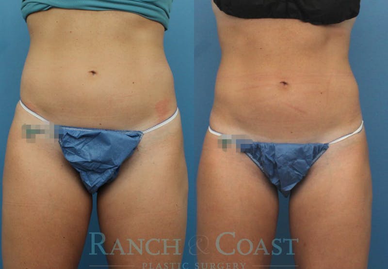 Coolsculpting Elite Before & After Gallery - Patient 189383870 - Image 1