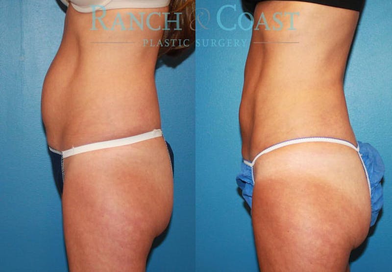 Coolsculpting Elite Before & After Gallery - Patient 189383909 - Image 1