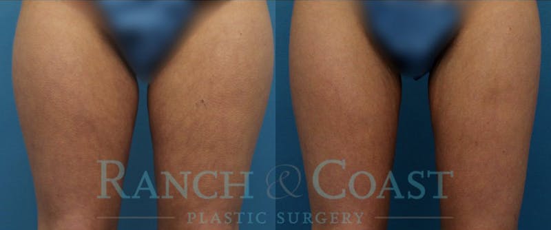 Coolsculpting Elite Before & After Gallery - Patient 189383908 - Image 1