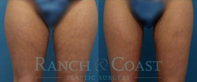 Coolsculpting Elite Before & After Gallery - Patient 189383908 - Image 1