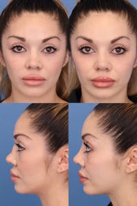 Female Revision Rhinoplasty Before & After Gallery - Patient 211998 - Image 1