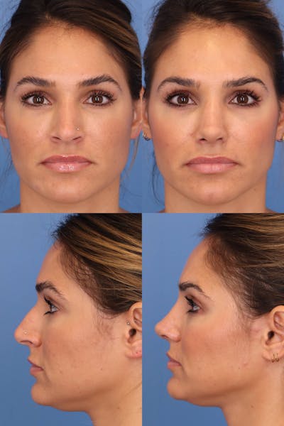 Female Dorsal Hump Before & After Gallery - Patient 368086 - Image 1