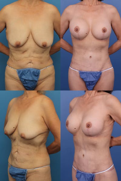 Mommy Makeover Before & After Gallery - Patient 305723 - Image 1