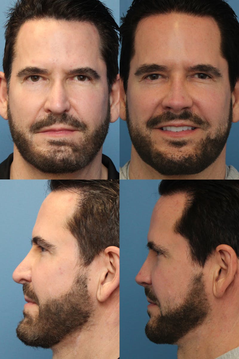 Rhinoplasty 12