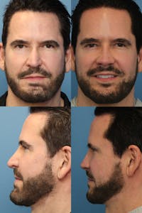 Male Rhinoplasty Before & After Gallery - Patient 287254 - Image 1