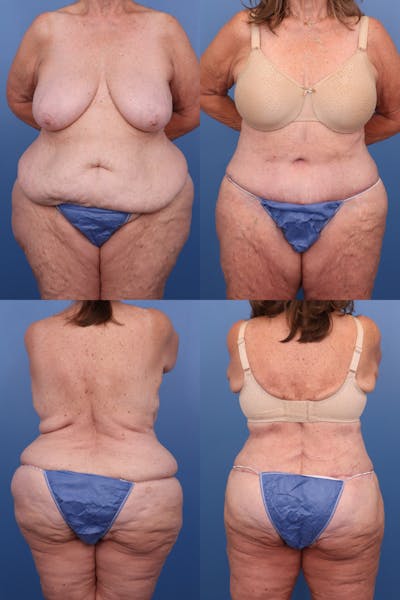 Body Lift / Thigh Lift Before & After Gallery - Patient 153081063 - Image 1