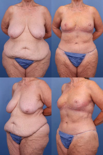 Mommy Makeover Before & After Gallery - Patient 424209 - Image 1