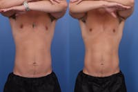 Coolsculpting Elite Before & After Gallery - Patient 156820 - Image 1