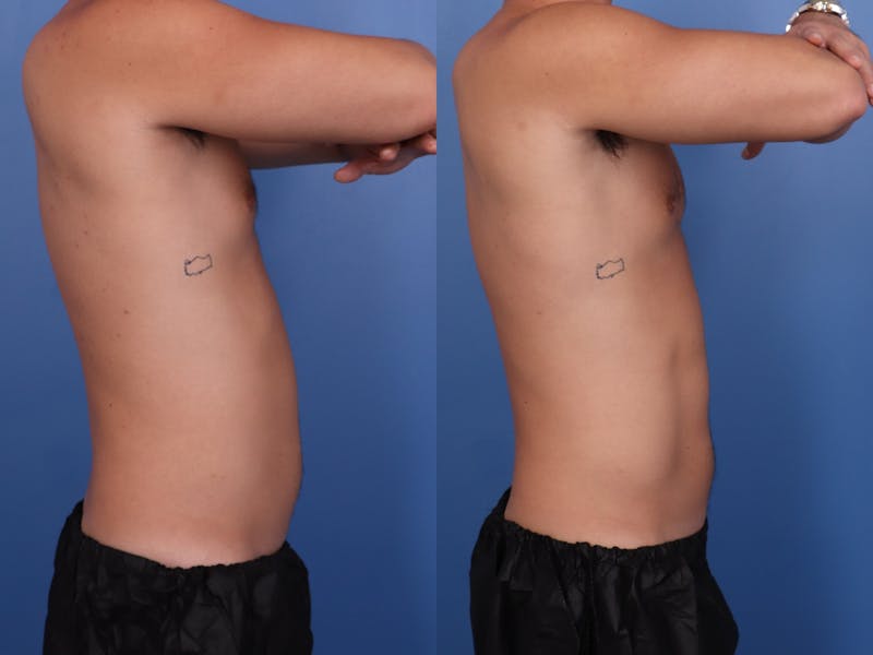 Coolsculpting Elite Before & After Gallery - Patient 492636 - Image 1