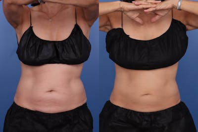 Coolsculpting Elite Before & After Gallery - Patient 402434 - Image 1