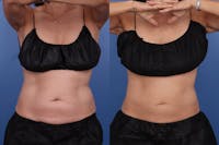 Coolsculpting Elite Before & After Gallery - Patient 402434 - Image 1