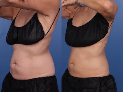 Coolsculpting Elite Before & After Gallery - Patient 533909 - Image 1