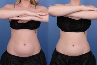 Coolsculpting Elite Before & After Gallery - Patient 423278 - Image 1