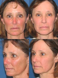 C02 Laser Rejuvenation Before & After Gallery - Patient 507143 - Image 1