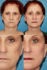 C02 Laser Rejuvenation Before & After Gallery - Patient 299877 - Image 1