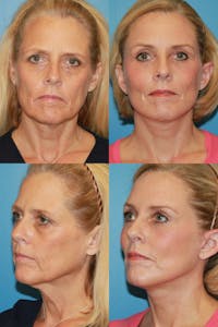 C02 Laser Rejuvenation Before & After Gallery - Patient 329729 - Image 1