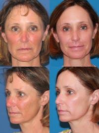 C02 Laser Rejuvenation Before & After Gallery - Patient 197907 - Image 1